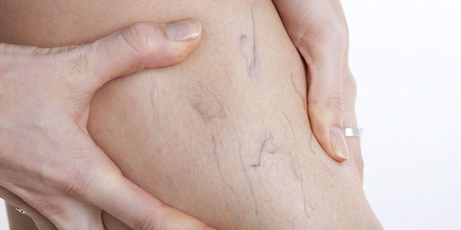 Radiofrequenza di endovenous ablyation di vene