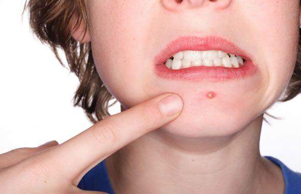 Crema aspra per la persona con pelle di problema