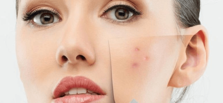 rimedi per cicatrici acne